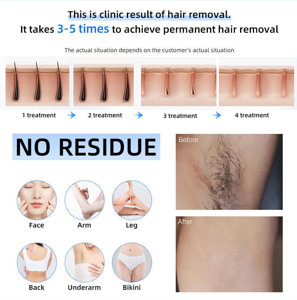 2024 Laser 2000W 808NM Diode L - Industrial Laser Hair Removal Machine recension och pris